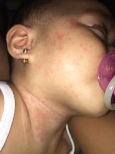 rashes or tigdas?
