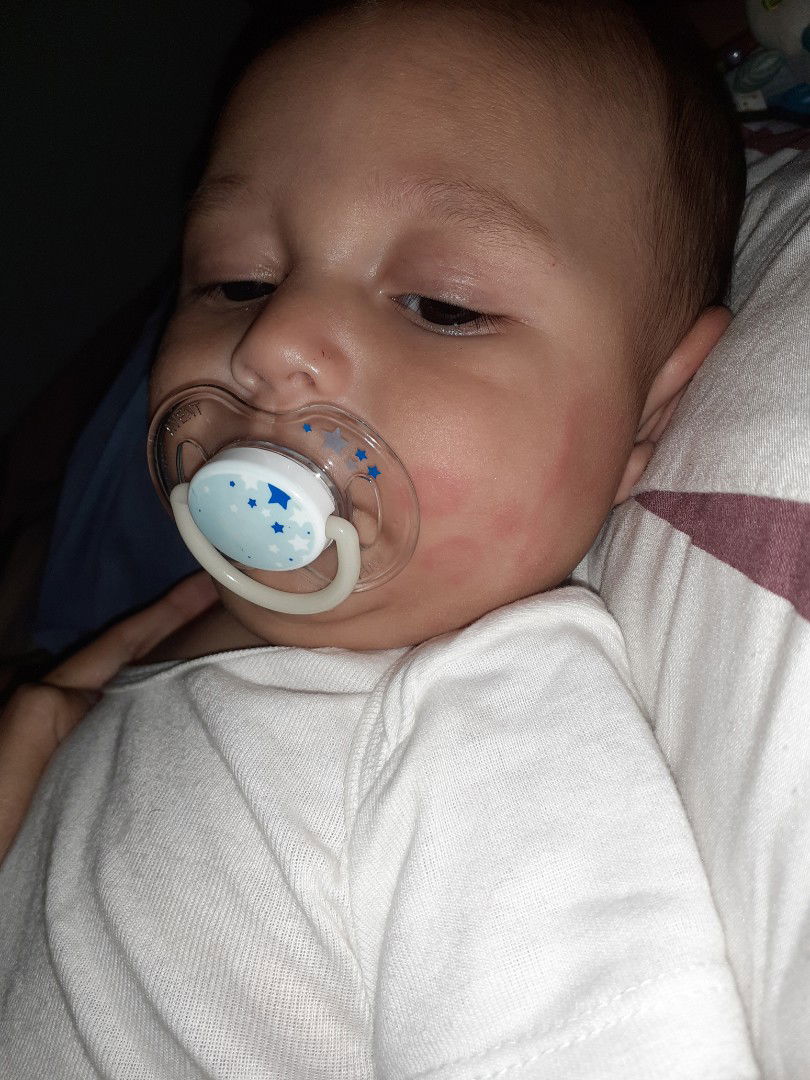 merah merah di tubuh bayi