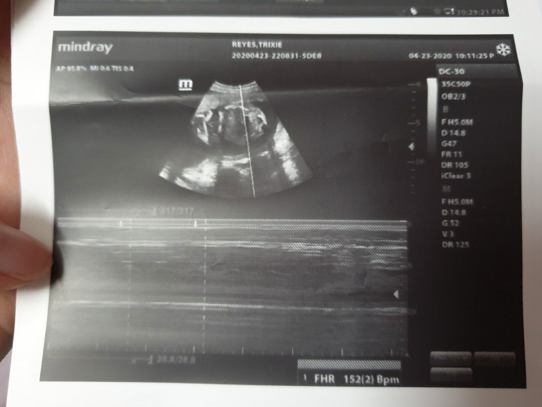 Big possibility na BABY GIRL