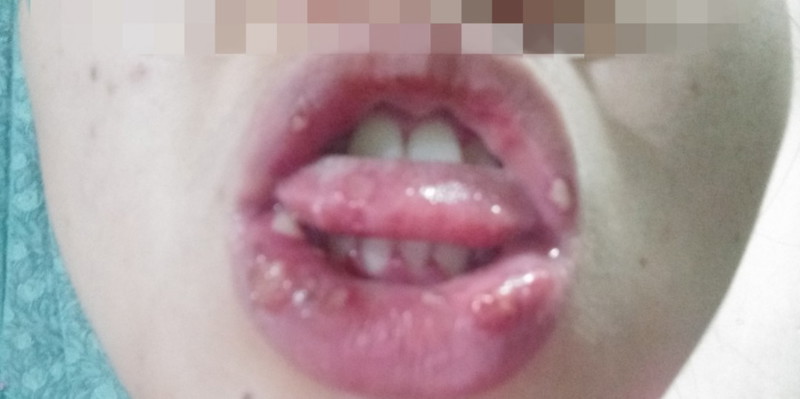 Singaw... Hi mga mommies, please help... normal lang ba iton