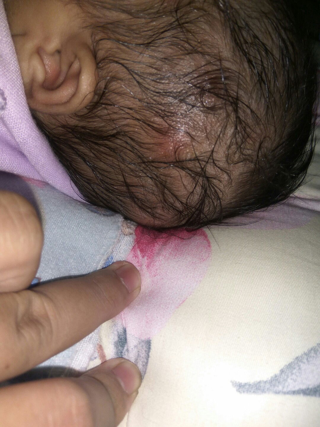 Bentol" Dkepala Bayi