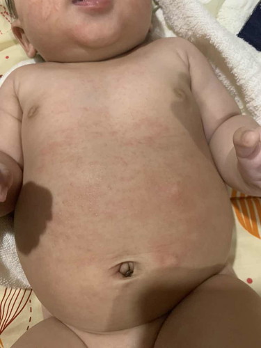 ผื่นเเดง