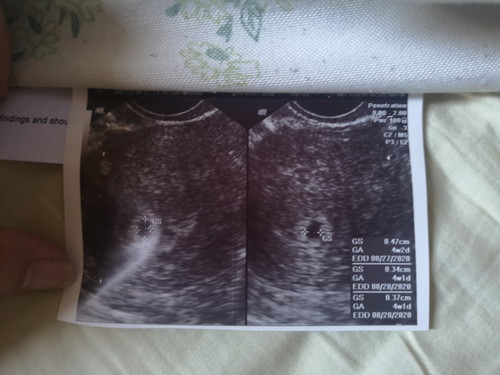 Transvaginal Ultrasound 4 Weeks