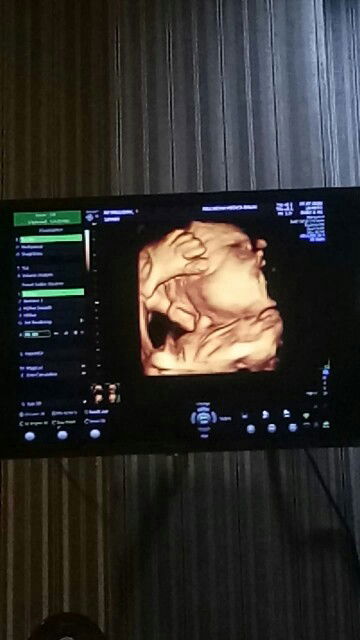 Dokter bilang defleksi?