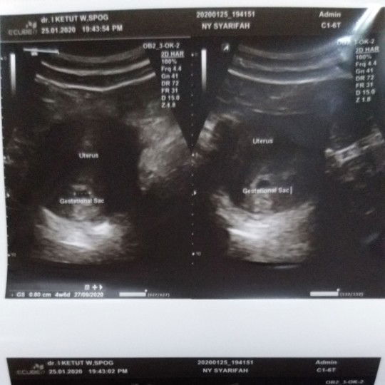 usg p1 usia kandungan 4w5d