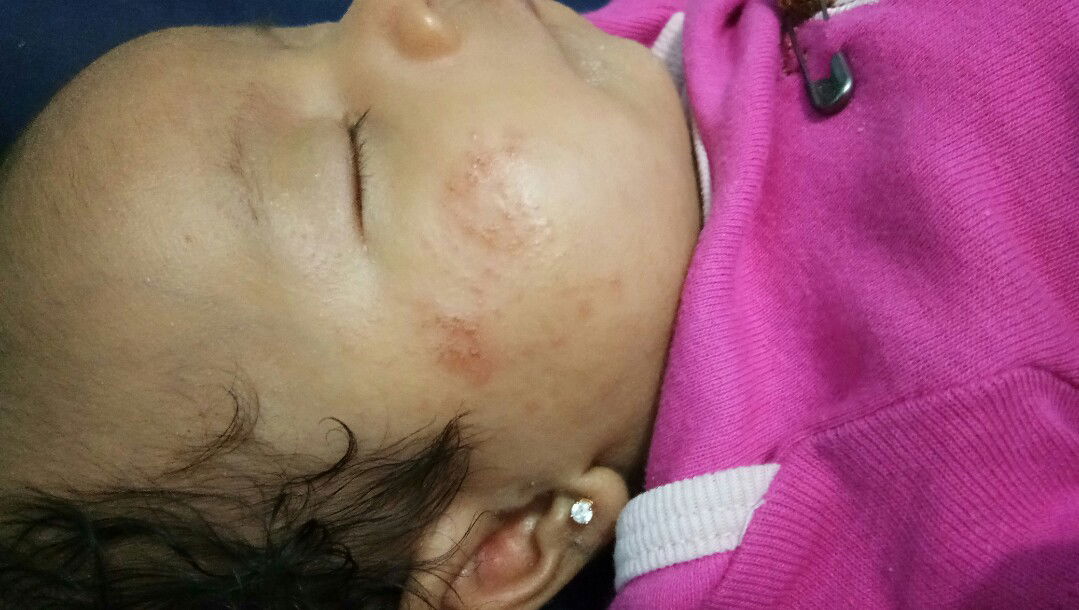 bercak merah di pipi