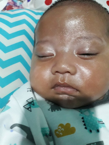 wajah bayi warna kulitnya tidak merata dan berkerak