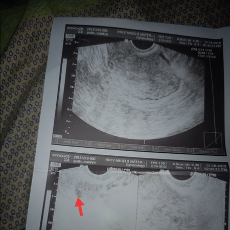 mga sis baka po my nakakaalam kung my baby napo ba yong matres ko hindi ko kc ma gets yong ob.salamat po
