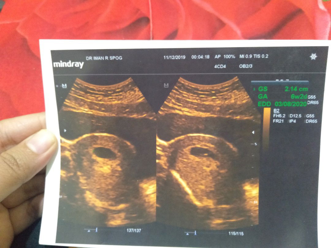 8 week belum terlihat janin