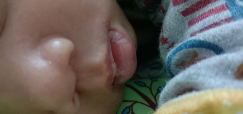 ลูกเป็นซางน้ำนมในปากค่ะ
