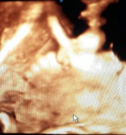 ถึงจะเป็นเบาหวานขณะตั้งครรภ์ต้องควบคุมอาหารน้ำหนักคุณแม่ไม่ค่อยขึ้นแต่น้ำหนักของคุณลูกขึ้นดีมากแค่นี้แม่ก็อุ่นใจค่ะ