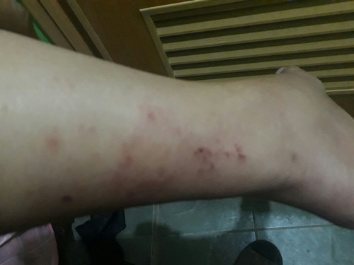Rashes