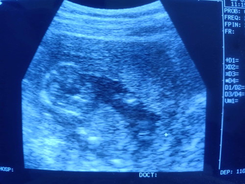 บ้านผมได้ลูกสาวครับ 30 Week แล้ว