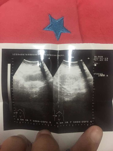 พอดีตรวจครรภ์ ขึ้นสองขีด พอไปหาหมอ หมอตรวจดูไม่เจอ บอกมดลูกไม่มีการขยาย เลยให้ตรวจปัสสาวะซ้ำ ผลก็ออกมา 2 ขีด แต่น่าทำไมคุณหมออัลตร้าซาวบอกเจอจุดเล็กๆ มดลูกไม่มีการขยายตัว