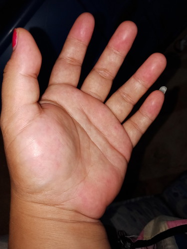 namamaga at sobrang manhid