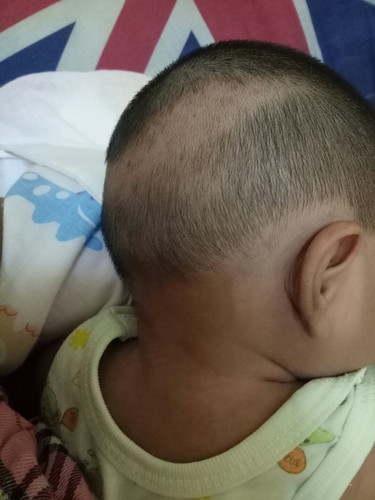 ขอถามหน่อยค่ะผมลูกขึ้นไม่เสมอกันเหมือนมีอะไรกัดเกิดจากอะไรคะแล้วแม่ๆพอจะรู้วิธีแก้บ้างมั้ยคะ?