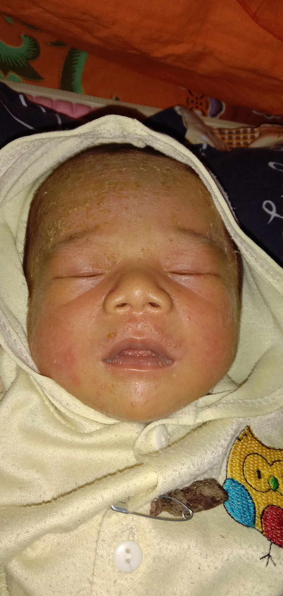 biang keringat atau alergi