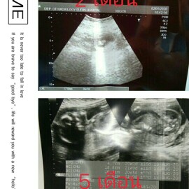 ขอดูรูปอัลตร้าซาวด์ของแม่ๆที่คลอดเดือนสิงหาคมหน่อยจ้า