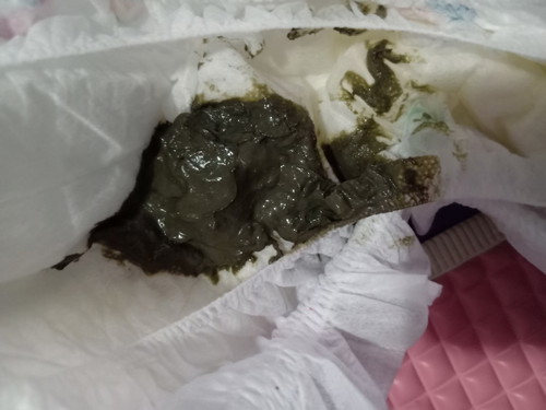 ลูกขับถ่ายเป็นสีแบบนี้เกิดจากอะไรคะแล้วควรทำอย่างไร