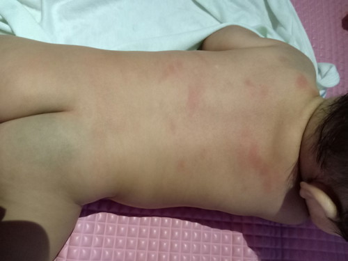 มีตุ่มแดงขึ้นหลัง