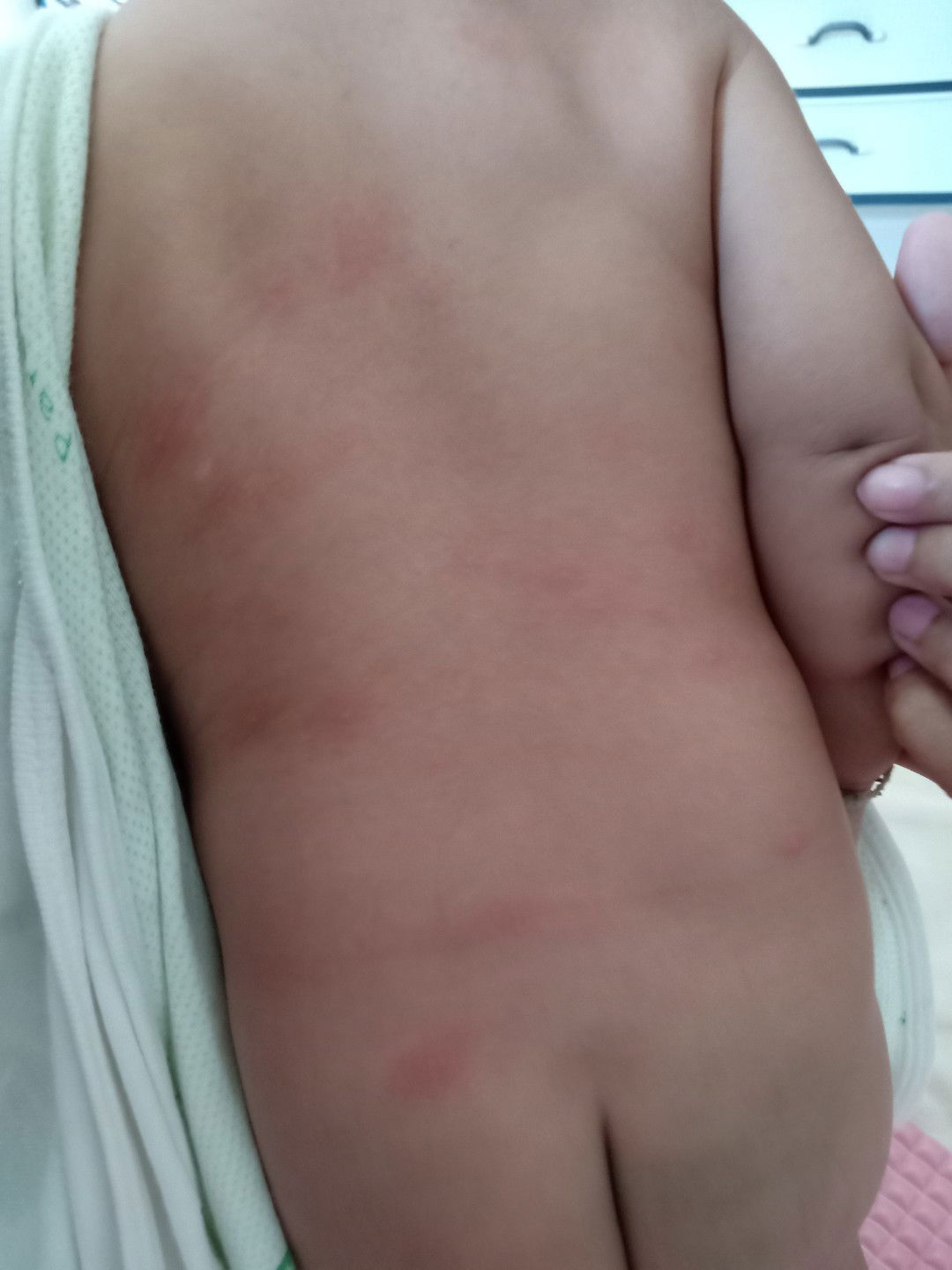 ตุ่มแดงเม็ดเล็ก