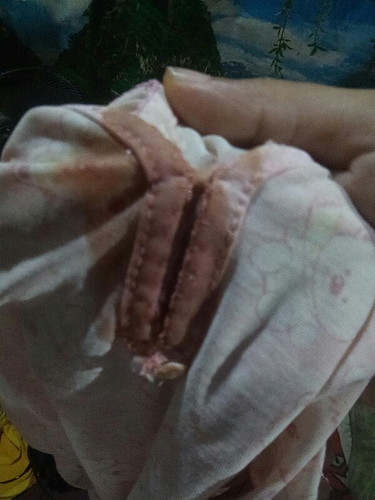 มีเลือดแบบนี้ออกมาจะเป็นไรไม่
