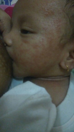 Pipi bayi merah