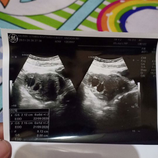 perkembangan janin kurang