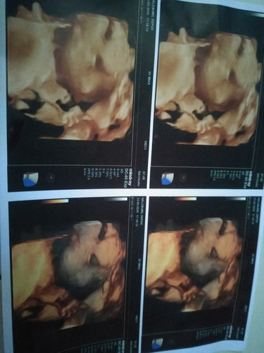 usia 24week