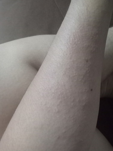 มีผื่นคัน
