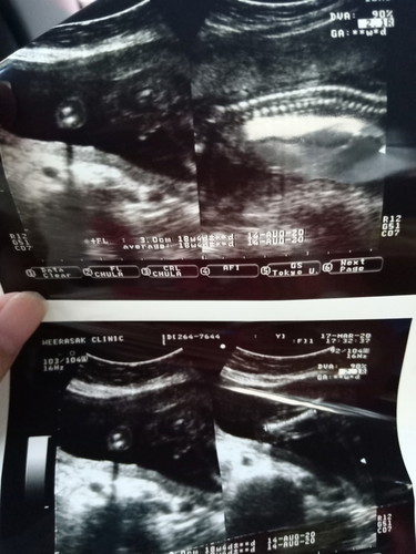เพศลูก