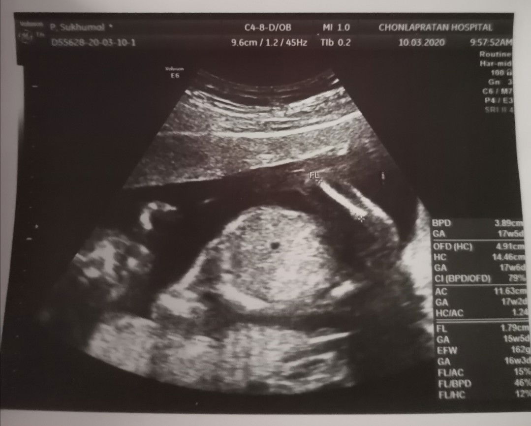 เจาะน้ำคร่ำครั้งแรกในชีวิต