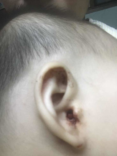 ลูกอายุ9เดือน มีเลือดออกที่หูเยอะ ไปหาหมอพบเป็นติ่งเนื้อ2ก้อน ควรตัดออกไหม จะเป็นอันตรายมากไหม ควรรักษาอย่างไรค่ะ