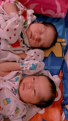 ประสบการณ์คลอดลูกแฝด ชาย หญิง  👧👦