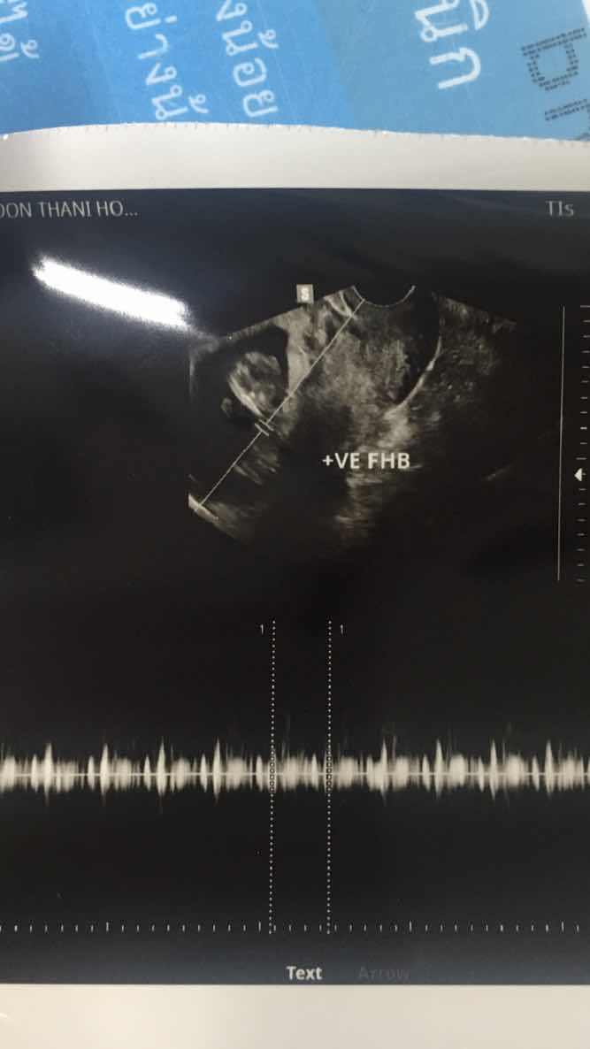 แท้งคุกคาม