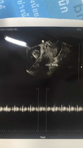 แท้งคุกคาม