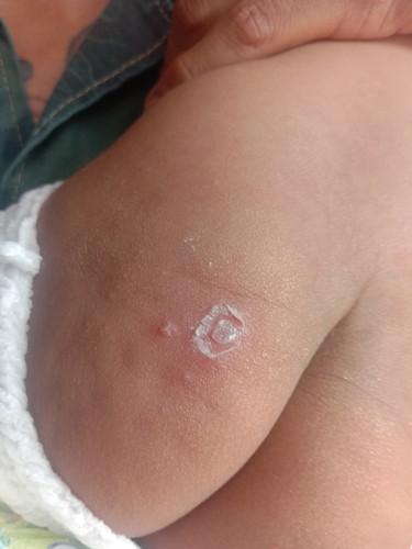 ขอสอบถามเเม่ๆ หลายๆไปบ้านหน่อยค่ะ ลูกชาย ได้ 4เดือน 13มีตุ้มน้ำใสๆเกิดที่ก้น ควรทำอย่างไรค่ะ