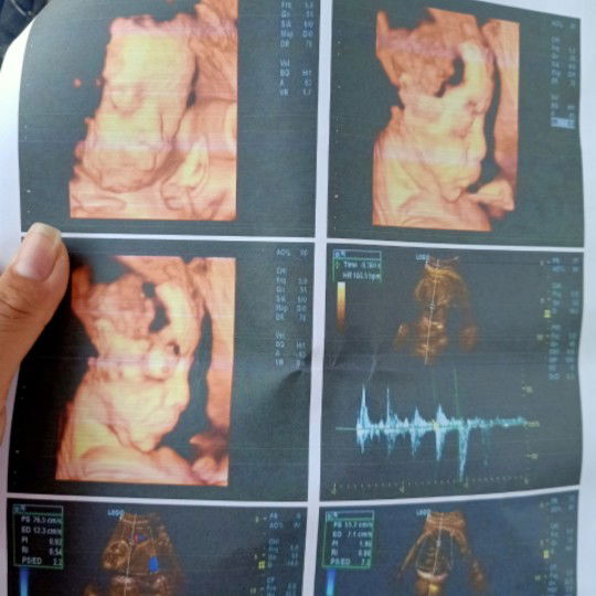 Con gái được 33 tuần.e mới đi sieu am để nhìn rõ con.ai cung bảo sao nhìn giống con trai.mọi người cho e chút ý kiến tham khảo đỡ hoang mang với ạ