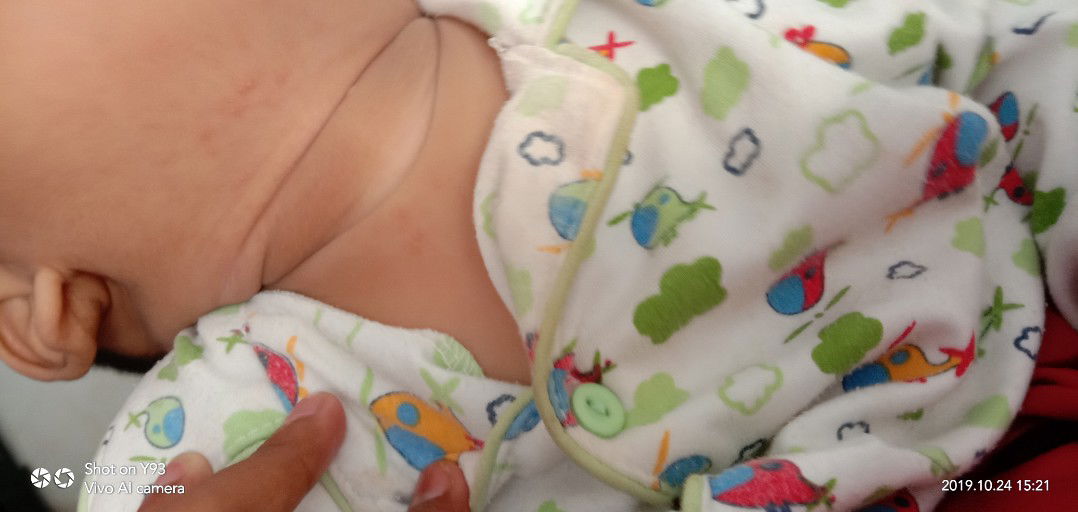 bintik bintik disertai nanah