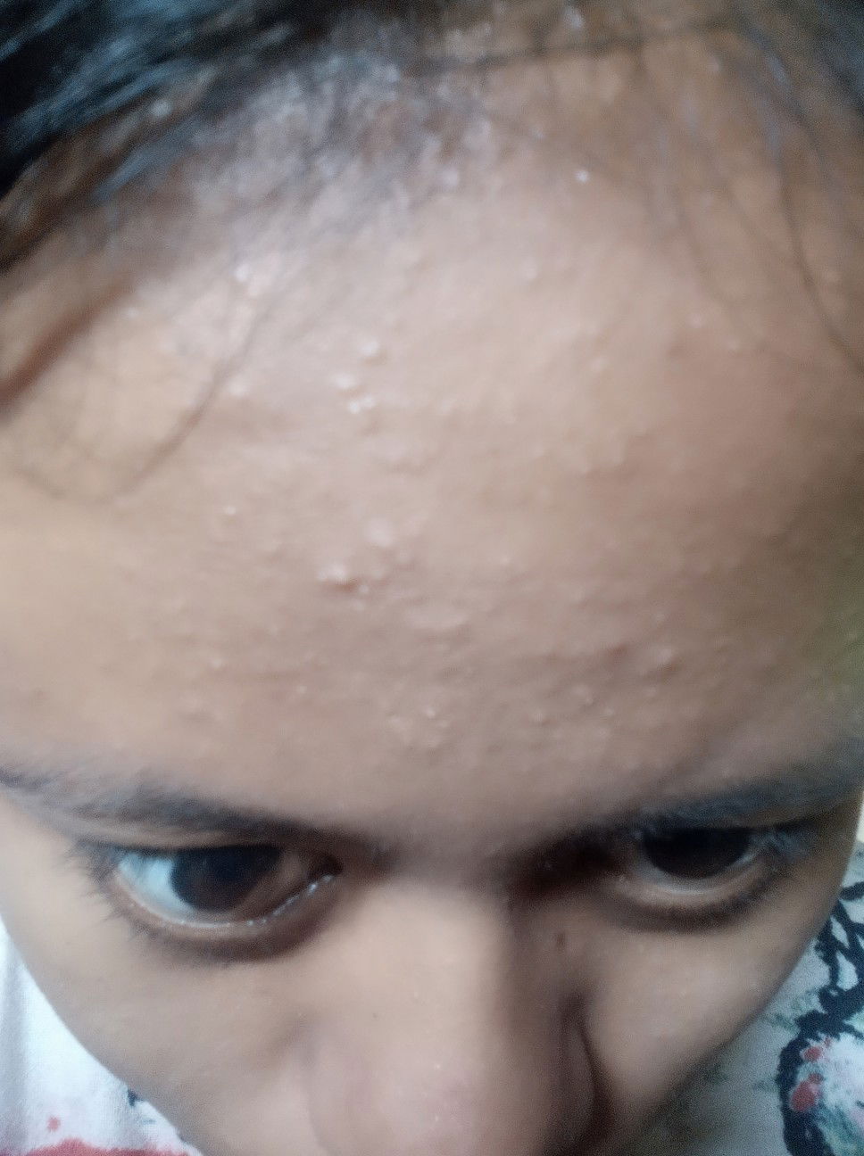 komedo, bibir pecah"