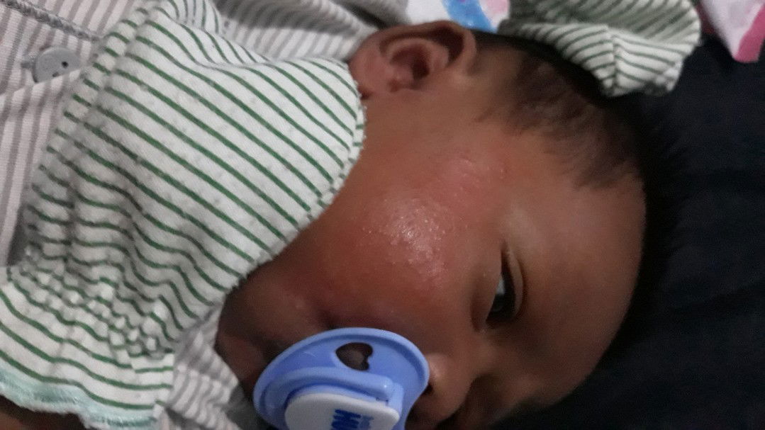 bitik2 merah pada anak