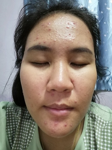 สิวเห่อ ไม่หาย