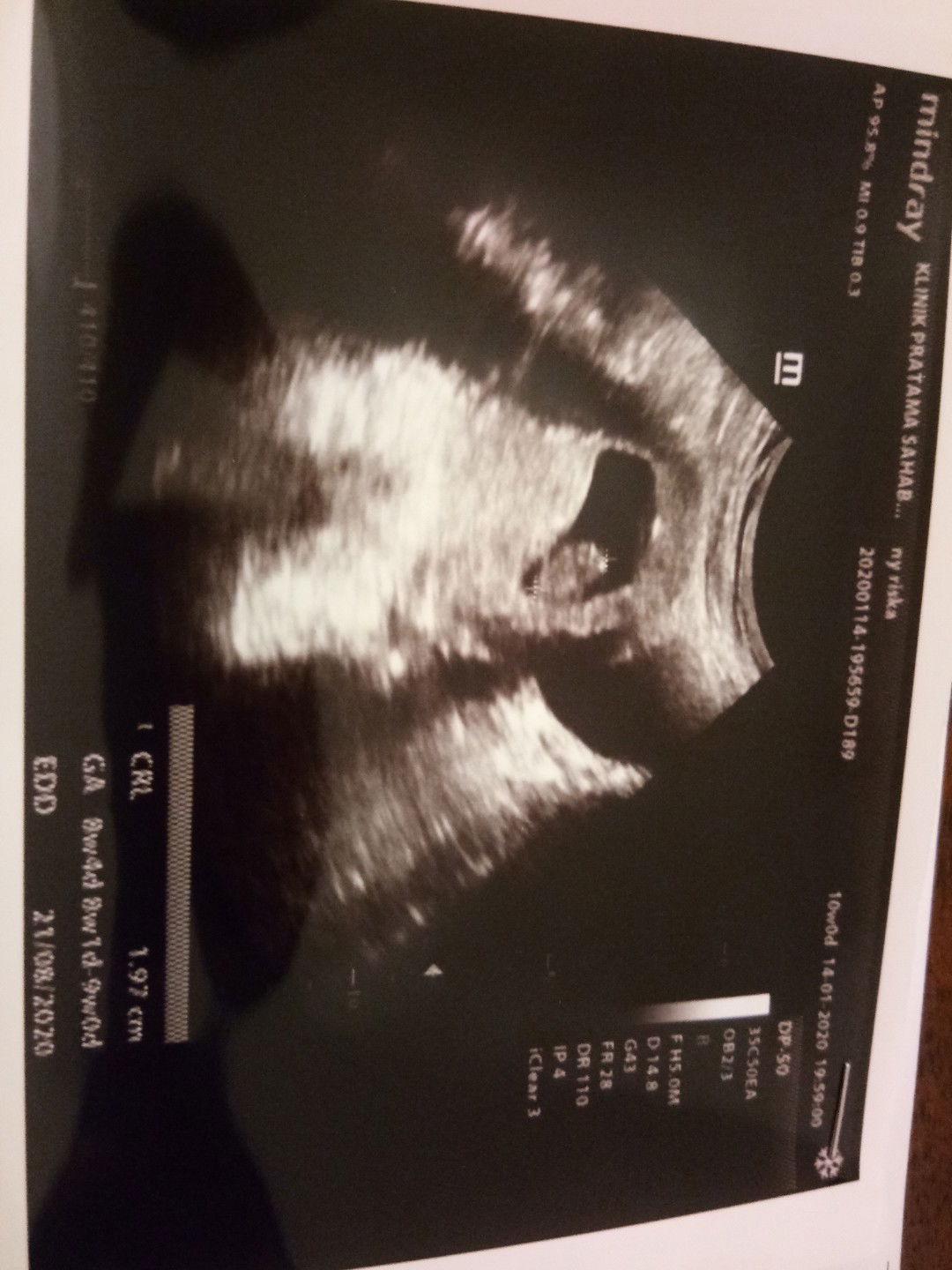 usg 2d pertama sakit perut normalkah?