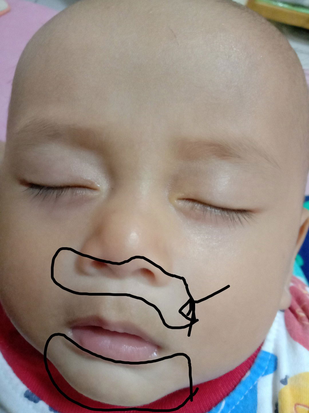 kulit berwarna lebih cerah dibanding kulit lain pada bayi