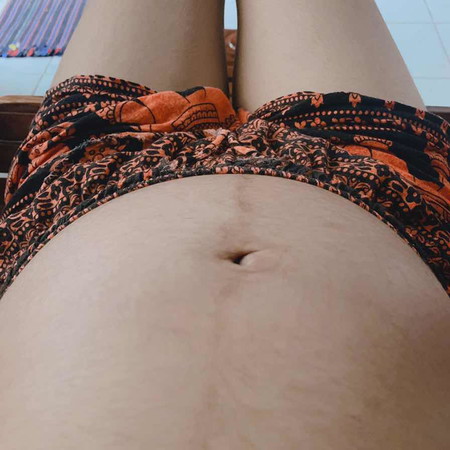 ท้องนูน