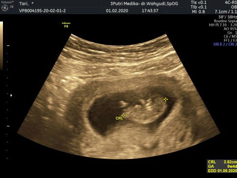 hasil usg selisih 2w dg HPHT