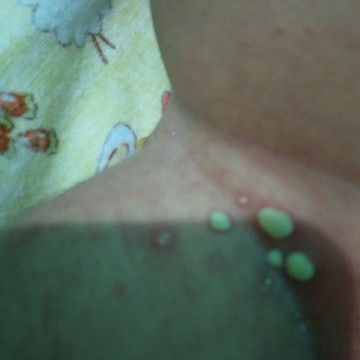 anak saya mempunyai bintik putih bernanah pada badannya