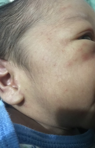 Rashes or normal?