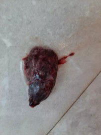 Tgl 15 Maret 2020 jam 09.24 saya mengalami flek coklat itupun usia kehamilan 7 minggu 3 hari lalu sore harinya mengalami pendarahan setelah memeriksakan ke dokter saya disuruh bedrest total n diberikan obat penguat kandungan.Pd tgl 17 Maret saya buang air