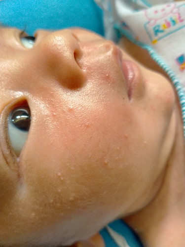 ผดที่หน้า